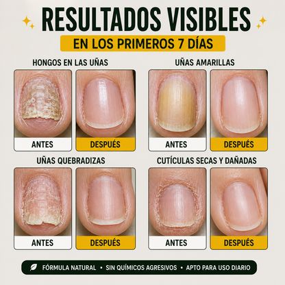 Suero de Jengibre King of Ginger - Uñas sanas y fuertes en 7 días